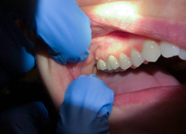 Best Emergency Tooth Extraction in New Hackensack, NY