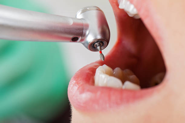 Best Emergency Treatment for Dental Infections or Abscesses in New Hackensack, NY